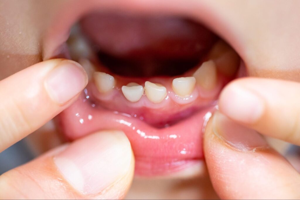 乳歯　歯並び