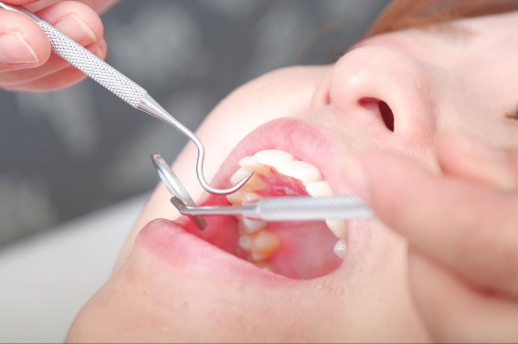 虫歯症状