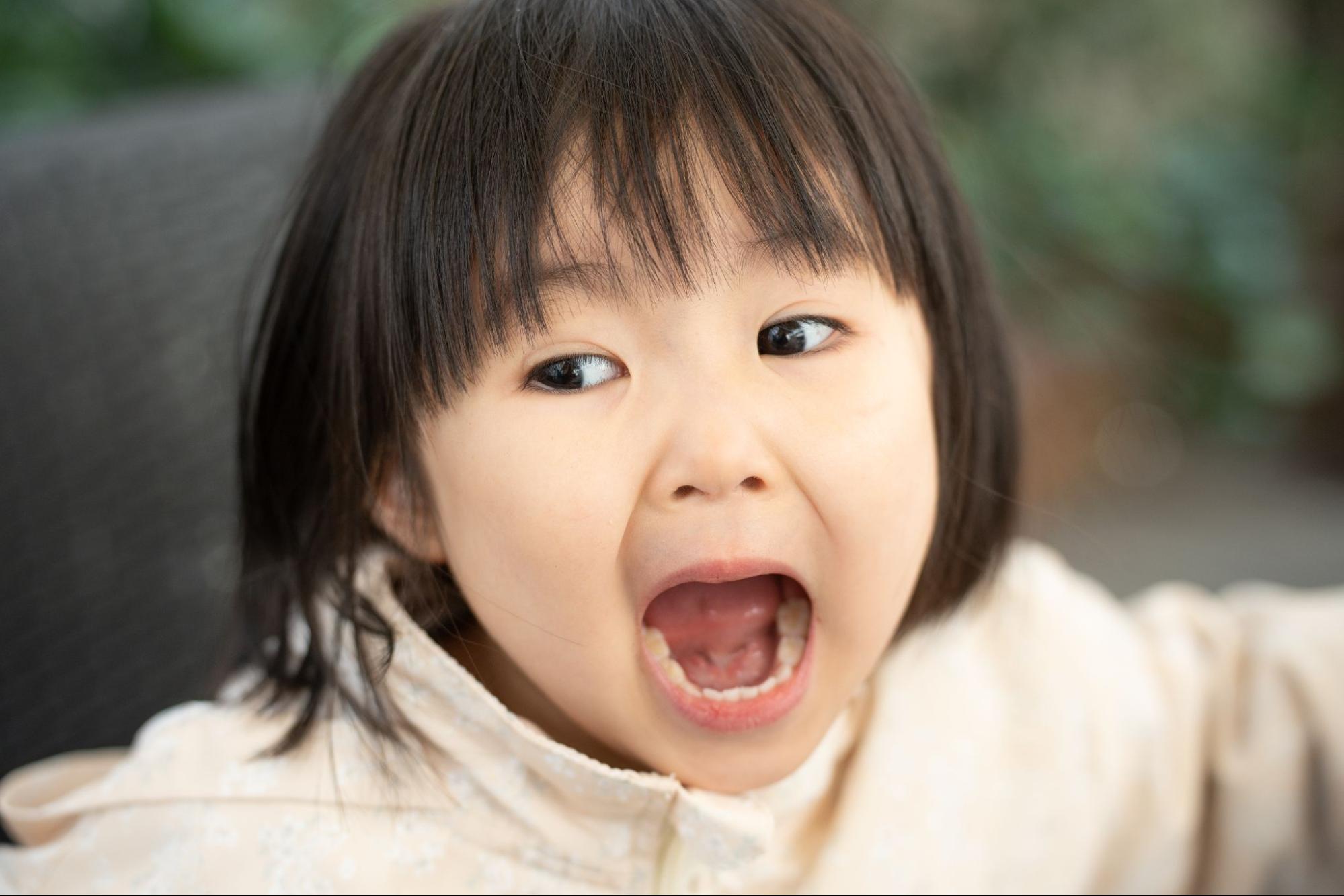 小児矯正 受け口
